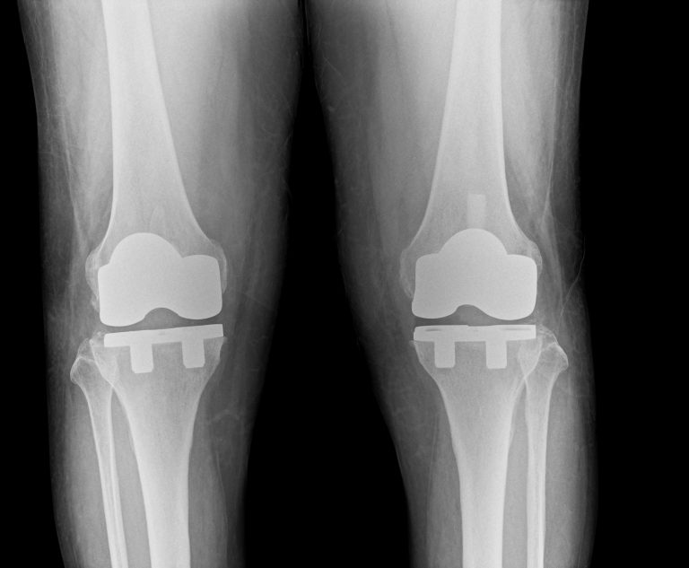 裁断済】人工膝関節全置換術[TKA]のすべて より安全に・より確実に その他